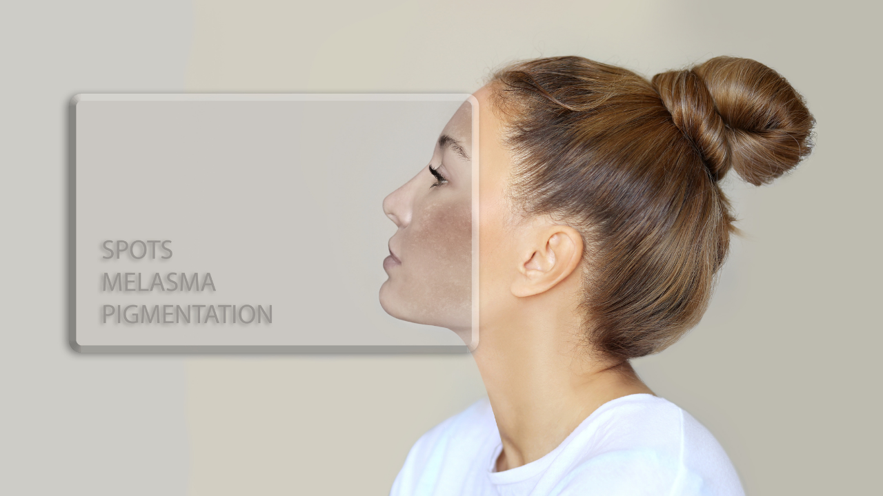 Cilt Lekeleri: Tedavi Seçenekleri ve Güneşten Korunma